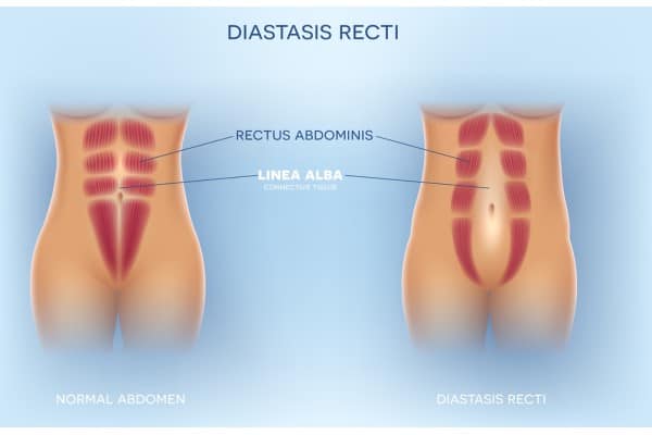 What Non-Surgical Options Are Available for Diastasis Recti Great Yarmouth?