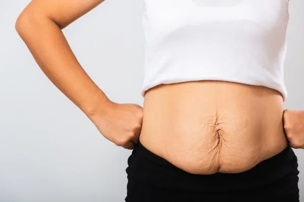 Image of a woman's stomach after weight loss with sagging skin following a gastric band Great Yarmouth